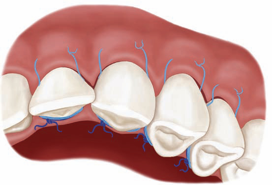 gum-graft